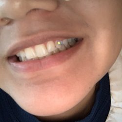 Tooth gems