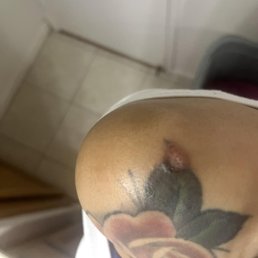 the technician hit my tattoo and burn off a chunk and then it got infected later the technician hit my tattoo and burn off a chunk and then it got infected later