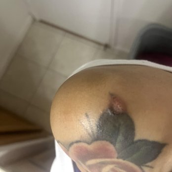 LaserAway - the technician hit my tattoo and burn off a chunk and then it got infected later - Medical Spas Near Me - Mountain View, California LaserAway - the technician hit my tattoo and burn off a chunk and then it got infected later - Medical Spas Near Me - Mountain View, California
