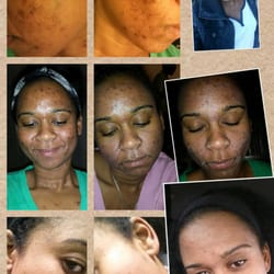 ibody - Started Cosmelan treatment for my acne scars and brown spots. This is from day 1 before and only 2 weeks after 1st face peel.