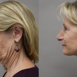 Deep plane Necklift and Facelift
