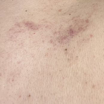 Relax Station 2 - Bruises on my back - Massage Therapy Near Me - Elk Grove, California Relax Station 2 - Bruises on my back - Massage Therapy Near Me - Elk Grove, California