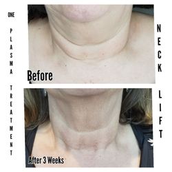 Lash On Wax Off - Plasma Pen Neck Treatment. Wrinkle reduction and lift.
You can see the tightness it created under her chin
