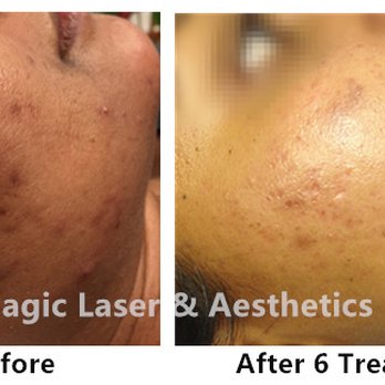 Magic Laser and Aesthetics - Acne Treatments - Laser Hair Removal Near Me - Toronto, Ontario