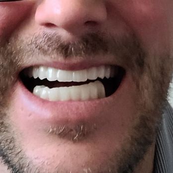 Bionic Smile - These were my teeth for a year - Cosmetic Dentists Near Me - Las Vegas, Nevada Bionic Smile - These were my teeth for a year - Cosmetic Dentists Near Me - Las Vegas, Nevada
