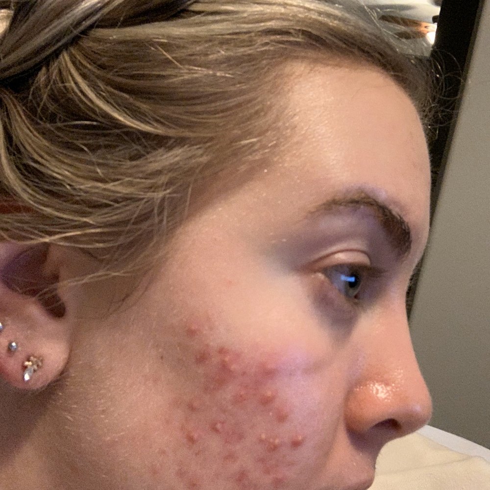 Ethereal Day Spa - This is my before photo. My skin hurt so badly - Skin Care Near Me - Temecula, California
