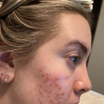Ethereal Day Spa - This is my before photo. My skin hurt so badly - Skin Care Near Me - Temecula, California Ethereal Day Spa - This is my before photo. My skin hurt so badly - Skin Care Near Me - Temecula, California