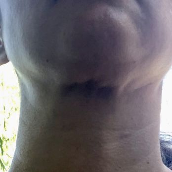Lauren Greenberg, MD - Under chin lipo botched, - Cosmetic Surgeons Near Me - Menlo Park, California