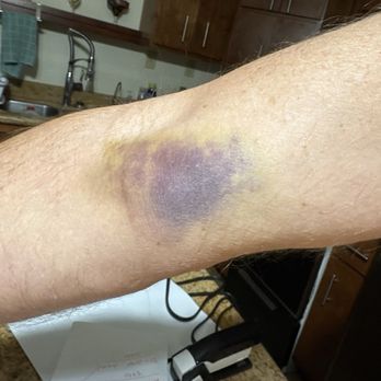 Labcorp - A little bruising?? - Laboratory Testing Near Me - Yuma, Arizona Labcorp - A little bruising?? - Laboratory Testing Near Me - Yuma, Arizona