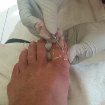 Mimi Nails - Digging out in grown toenails. Feels so much better! - Nail Salons Near Me - Castro Valley, California Mimi Nails - Digging out in grown toenails. Feels so much better! - Nail Salons Near Me - Castro Valley, California