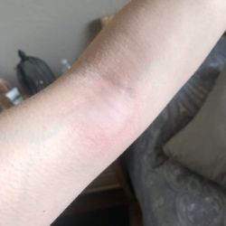 SimonMed Imaging - Buckeye - Lump from IV contrast extravasation, very painful