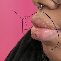 Inkology - Allergic reaction to the metal of the piercing