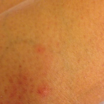 Hyatt Place Uc Davis - Insect bites on my leg. - Hotels Near Me - Davis, California