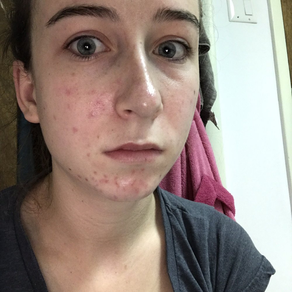 This after being home for two hours, definitely doesn't look like I had a facial and my face was clear before I went in there This after being home for two hours, definitely doesn't look like I had a facial and my face was clear before I went in there