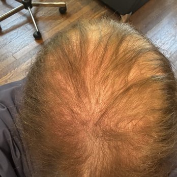The Hair Specialist - I have so much hair due to medical conditions. - Hair Extensions Near Me - Stow, Ohio The Hair Specialist - I have so much hair due to medical conditions. - Hair Extensions Near Me - Stow, Ohio