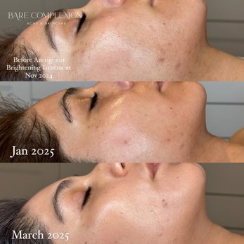 Bare Complexion - Before and after using Epicutis Arctigenin Brightening Treatment. Available for purchase at Bare Complexion Acne & Skincare in Ventura, Ca - Skin Care Near Me - Ventura, California