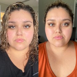 ImageLift - Left is before, right is 4 days after Botox injections.