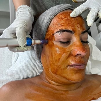 Endless Beauty by Katia - Nono-needling - Skin Care Near Me - Corona, California Endless Beauty by Katia - Nono-needling - Skin Care Near Me - Corona, California