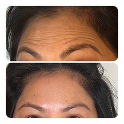 Body By Lonnie Med Spa - Before and After Botox results. Look 10 years younger by relaxing and decreasing the appearance of fine lines.