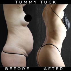 Matthew J Nykiel, MD - Tummy Tuck Before and After