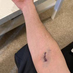 LifeLabs - This happened after a blood test at LifeLabs. Unprofessional handling, painful experience, and completely unacceptable.