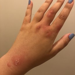 Bedbug bite Bedbug bite
