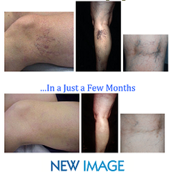 New Image Medical Aesthetics & Wellness - Sclerotherapy Results