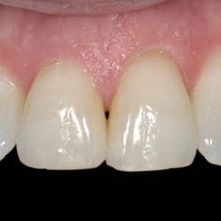 Phelan Dental - Before Porcelain Veneers. This patient had old bonding and a flat tooth contour that we corrected with porcelain veneers.