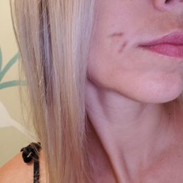 Face scars left from filler malpractice Face scars left from filler malpractice