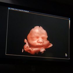 First View Ultrasound