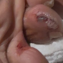 Infected toe after rubbed raw by manicurist