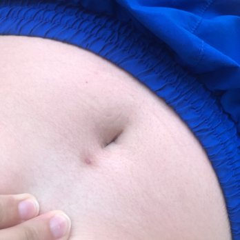 Sadu Body Piercing & Modifications - My scar above my bellybutton - Piercing Near Me - Charlotte, North Carolina Sadu Body Piercing & Modifications - My scar above my bellybutton - Piercing Near Me - Charlotte, North Carolina