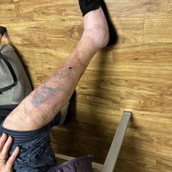 Lacamas Creek Post Acute - Blood clot caused by Prestige Care van incident - Skilled Nursing Near Me - Camas, Washington Lacamas Creek Post Acute - Blood clot caused by Prestige Care van incident - Skilled Nursing Near Me - Camas, Washington