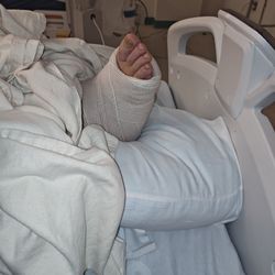 Rosemont Brookhaven - His ankle after the emergency surgery
