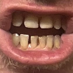 Catalina Foothills Family Dental - Gaps in my teeth