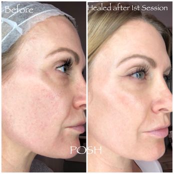 Posh Aesthetics - Microneedling every 4 -6 weeks is key to the aging process! - Skin Care Near Me - Brentwood, California Posh Aesthetics - Microneedling every 4 -6 weeks is key to the aging process! - Skin Care Near Me - Brentwood, California