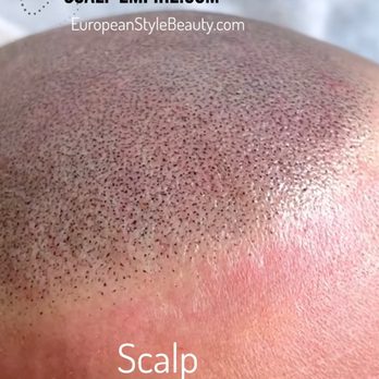 Scalp Empire Studio - Scalp Micropigmentation - Hair Loss Centers Near Me - Midlothian, Virginia Scalp Empire Studio - Scalp Micropigmentation - Hair Loss Centers Near Me - Midlothian, Virginia