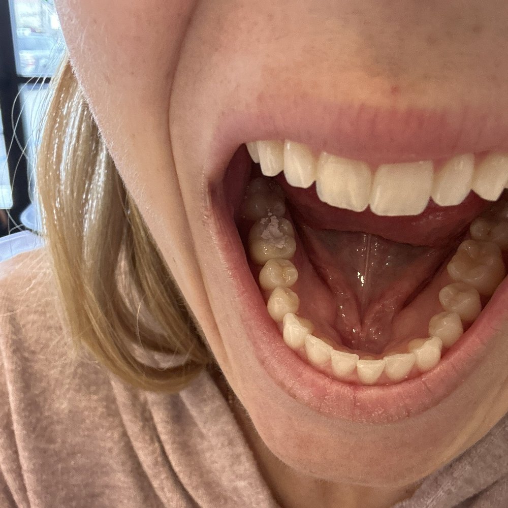 Delta Endodontics - The filling the Stockton office "fixed". - General Dentistry Near Me - Stockton, California