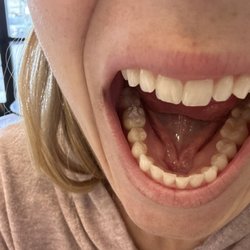 Delta Endodontics - The filling the Stockton office "fixed".