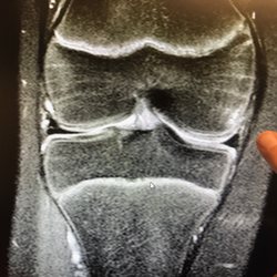 All-Star Orthopedics of Austin - Bone bruise and slight MCL tear