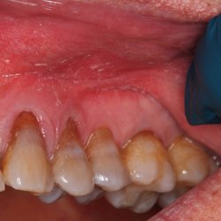 Johnson Scott F DMD Ms - Before. Note the receding gum line on all 4 teeth. Very unsightly.