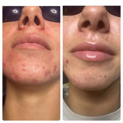 512 Skincare - Hormonal acne and scarring