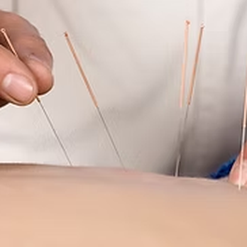 Le Sueur - Dry Needling - Physical Therapy Near Me - Mesa, Arizona Le Sueur - Dry Needling - Physical Therapy Near Me - Mesa, Arizona