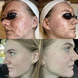 Beauty By Victoria - Before and after pictures of actual Face Reality treatments by Victoria.