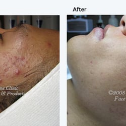 Renee Katherine Acne Clinic - Acne type: combination. Before and After