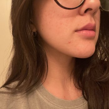La Jolla Acne Specialists - Acne Treatment Near Me - San Diego, California La Jolla Acne Specialists - Acne Treatment Near Me - San Diego, California