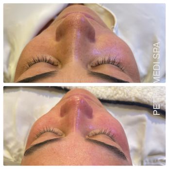 Petra Medi Spa - Before and after HydraFacial - Medical Spas Near Me - Encino, California Petra Medi Spa - Before and after HydraFacial - Medical Spas Near Me - Encino, California