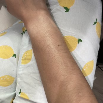Satori Laser - Union Square - Growth after my 13th session!! Full on growth! - Laser Hair Removal Near Me - New York, New York Satori Laser - Union Square - Growth after my 13th session!! Full on growth! - Laser Hair Removal Near Me - New York, New York