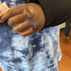 St. Joseph's Behavioral Health Center - His arm in sling from receiving a Proximal Humerus fracture and raw knuckles all while in St Joseph Behavioral Center care in Stockton.