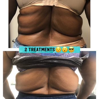 Inspire Beauty - Real Client...Real Result! 2 treatments! - Body Contouring Near Me - Austin , Texas Inspire Beauty - Real Client...Real Result! 2 treatments! - Body Contouring Near Me - Austin , Texas